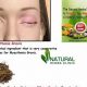Natural Myasthenia Gravis Herbal Treatment: Relief + Support | The Ultimate Herbal Remedies Guide: Natural Healing for a Healthier Life