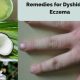 Natural Dyshidrotic Eczema Herbal Remedies: Relief Guide | The Ultimate Herbal Remedies Guide: Natural Healing for a Healthier Life