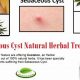 Natural Sebaceous Cyst Herbal Treatment: Relief & Remedies | The Ultimate Herbal Remedies Guide: Natural Healing for a Healthier Life