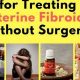 Natural Herbal Treatment for Uterine Fibroids: A Guide | The Ultimate Herbal Remedies Guide: Natural Healing for a Healthier Life