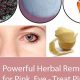 Natural Herbal Remedies for Pink Eye Relief Now | The Ultimate Herbal Remedies Guide: Natural Healing for a Healthier Life