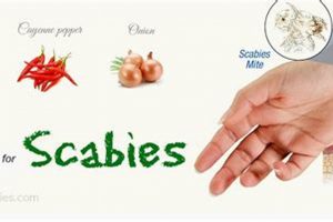 Natural Herbal Cure for Scabies: Relief & Remedies The Ultimate Herbal Remedies Guide: Natural Healing for a Healthier Life Natural Herbal Cure for Scabies: Relief & Remedies | The Ultimate Herbal Remedies Guide: Natural Healing for a Healthier Life