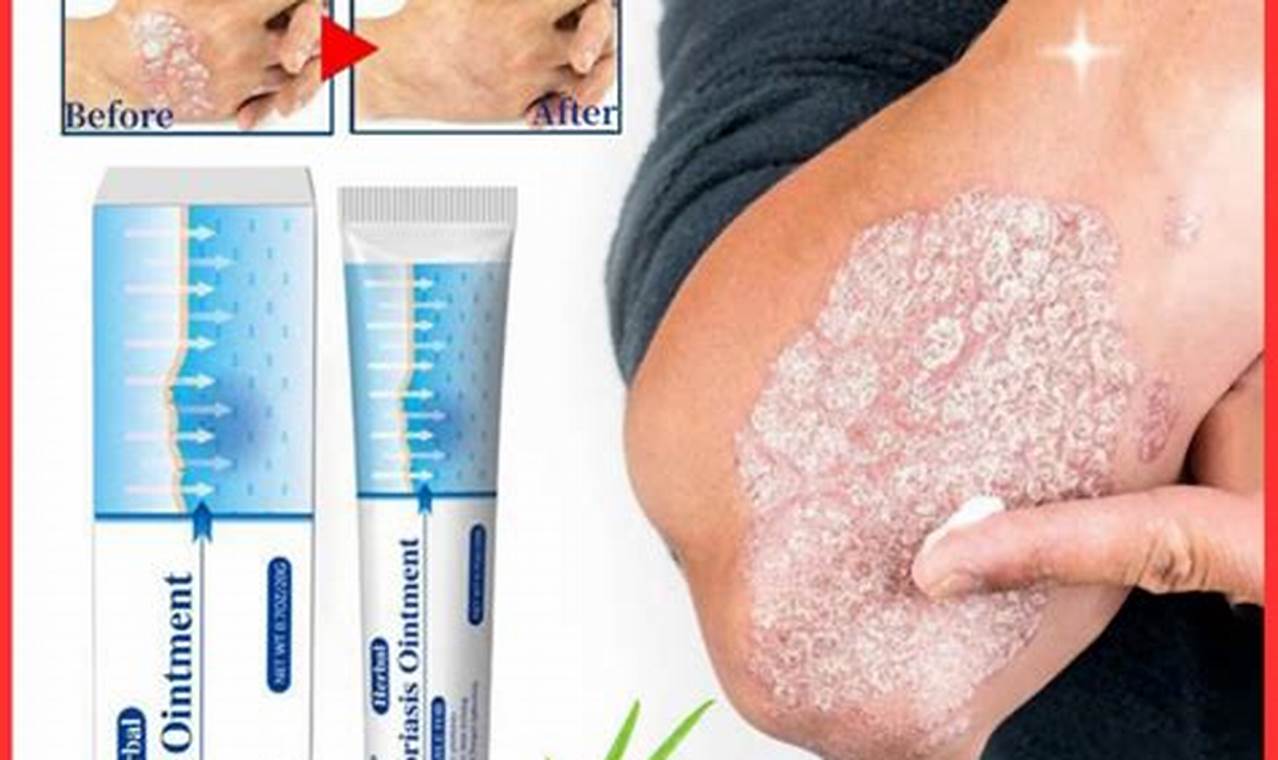 Natural Psoriasis Relief: Herbal Ointment Reviews & Tips The Ultimate Herbal Remedies Guide: Natural Healing for a Healthier Life Natural Psoriasis Relief: Herbal Ointment Reviews & Tips | The Ultimate Herbal Remedies Guide: Natural Healing for a Healthier Life