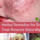 Natural Rosacea Treatment: Herbal Remedies That Work | The Ultimate Herbal Remedies Guide: Natural Healing for a Healthier Life