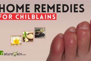 Natural Chilblains Herbal Treatment Relief Guide The Ultimate Herbal Remedies Guide: Natural Healing for a Healthier Life Natural Chilblains Herbal Treatment Relief Guide | The Ultimate Herbal Remedies Guide: Natural Healing for a Healthier Life