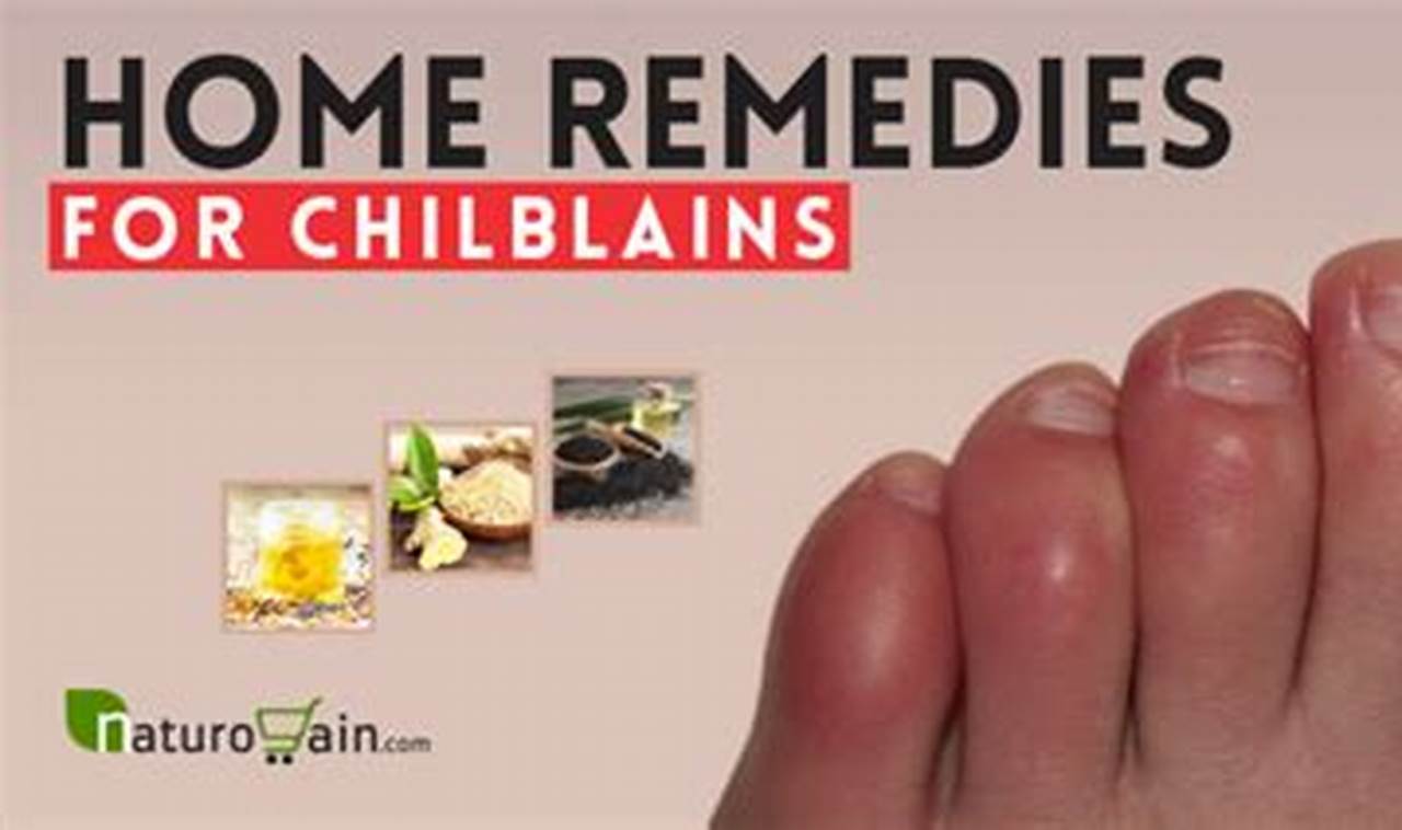 Natural Chilblains Herbal Treatment Relief Guide The Ultimate Herbal Remedies Guide: Natural Healing for a Healthier Life Natural Chilblains Herbal Treatment Relief Guide | The Ultimate Herbal Remedies Guide: Natural Healing for a Healthier Life