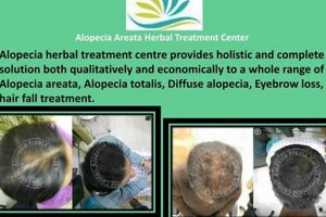 Natural Alopecia Herbal Treatment Boosters The Ultimate Herbal Remedies Guide: Natural Healing for a Healthier Life Natural Alopecia Herbal Treatment Boosters | The Ultimate Herbal Remedies Guide: Natural Healing for a Healthier Life