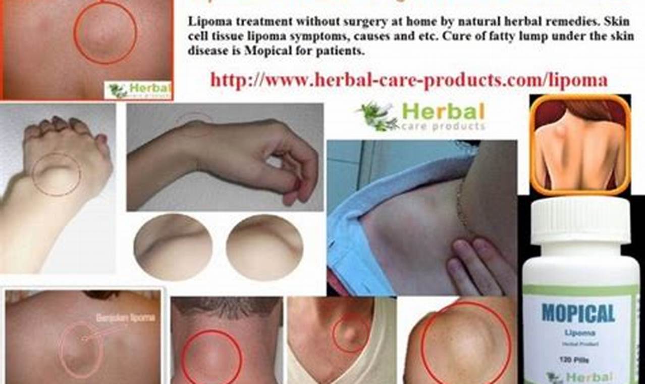 Natural Herbal Treatment for Lipoma: Relief & Remedies The Ultimate Herbal Remedies Guide: Natural Healing for a Healthier Life Natural Herbal Treatment for Lipoma: Relief & Remedies | The Ultimate Herbal Remedies Guide: Natural Healing for a Healthier Life