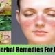 Natural Herbal Remedies for Lupus: Relief & Support | The Ultimate Herbal Remedies Guide: Natural Healing for a Healthier Life