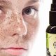 Best Herbal Treatment for Face Spots: Natural Remedies | The Ultimate Herbal Remedies Guide: Natural Healing for a Healthier Life