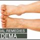 Natural Herbal Remedies for Edema in Legs: Relief Tips | The Ultimate Herbal Remedies Guide: Natural Healing for a Healthier Life