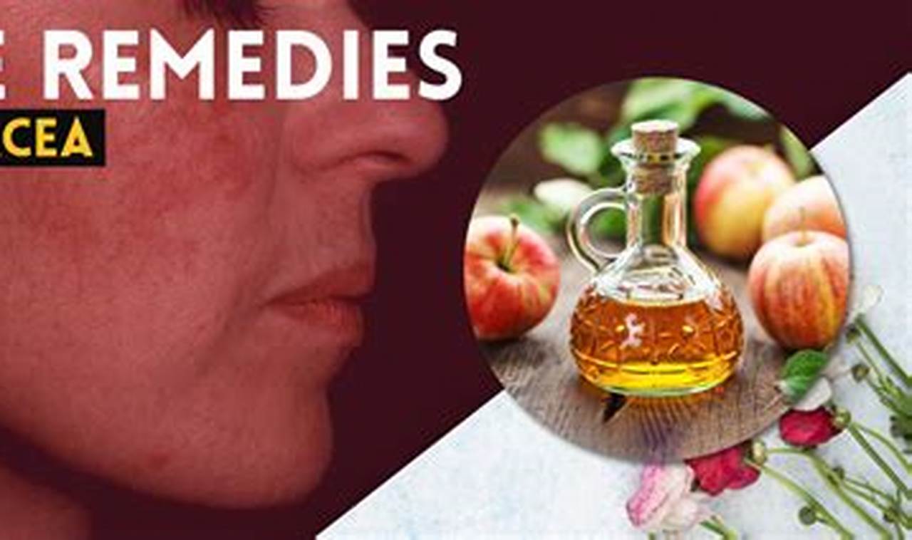 Natural Rosacea Herbal Remedies: Soothe & Calm | The Ultimate Herbal Remedies Guide: Natural Healing for a Healthier Life