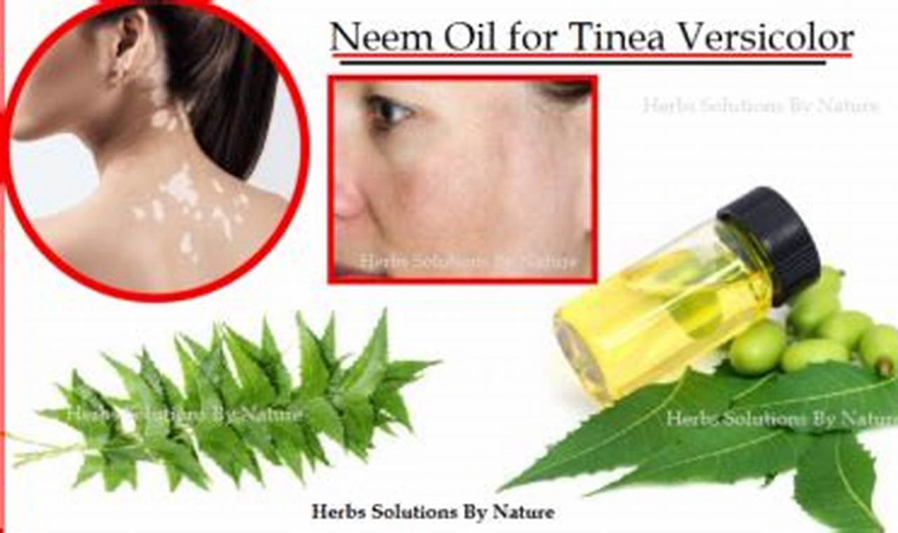 Natural Relief: Tinea Versicolor Herbal Treatment Guide | The Ultimate Herbal Remedies Guide: Natural Healing for a Healthier Life
