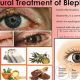 Natural Blepharitis Herbal Treatment: Soothe Eyes Fast | The Ultimate Herbal Remedies Guide: Natural Healing for a Healthier Life
