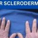 Natural Scleroderma Herbal Remedies: Relief + Support | The Ultimate Herbal Remedies Guide: Natural Healing for a Healthier Life