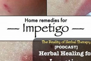Natural Herbal Remedies for Impetigo Relief Today | The Ultimate Herbal Remedies Guide: Natural Healing for a Healthier Life