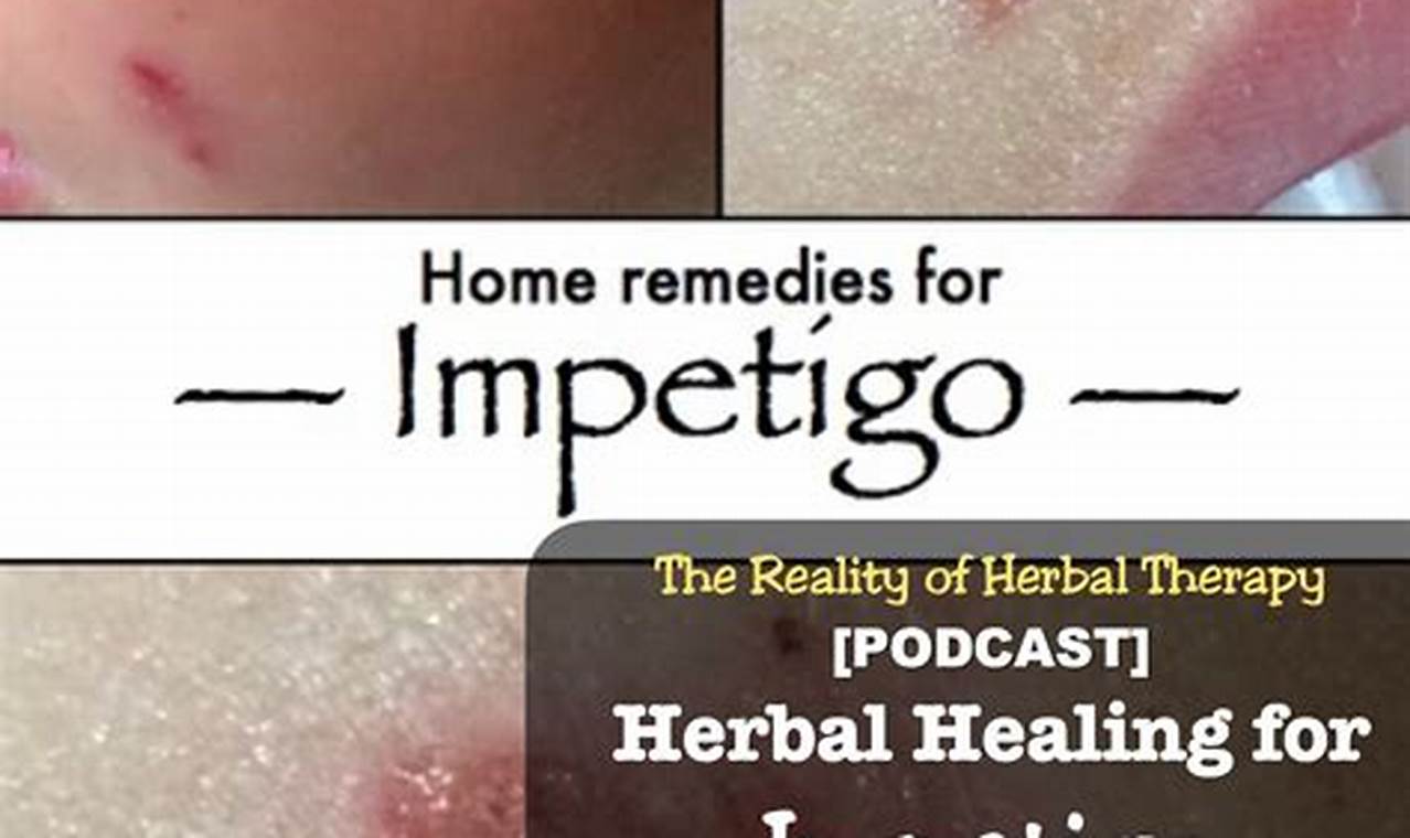 Natural Herbal Remedies for Impetigo Relief Today | The Ultimate Herbal Remedies Guide: Natural Healing for a Healthier Life