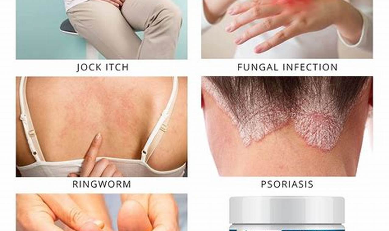 Natural Herbal Antifungal Supplement: Uses & Benefits | The Ultimate Herbal Remedies Guide: Natural Healing for a Healthier Life