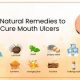 Natural Herbal Remedies for Mouth Ulcers Relief | The Ultimate Herbal Remedies Guide: Natural Healing for a Healthier Life