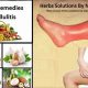 Natural Herbal Remedies for Cellulitis Relief Today | The Ultimate Herbal Remedies Guide: Natural Healing for a Healthier Life