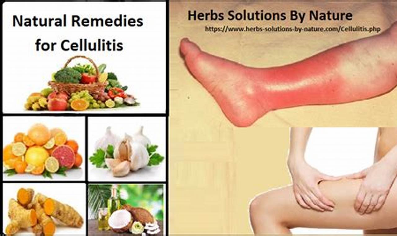 Natural Herbal Remedies for Cellulitis Relief Today | The Ultimate Herbal Remedies Guide: Natural Healing for a Healthier Life