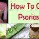 Best Natural Herbal Treatment for Psoriasis: Relief Guide | The Ultimate Herbal Remedies Guide: Natural Healing for a Healthier Life