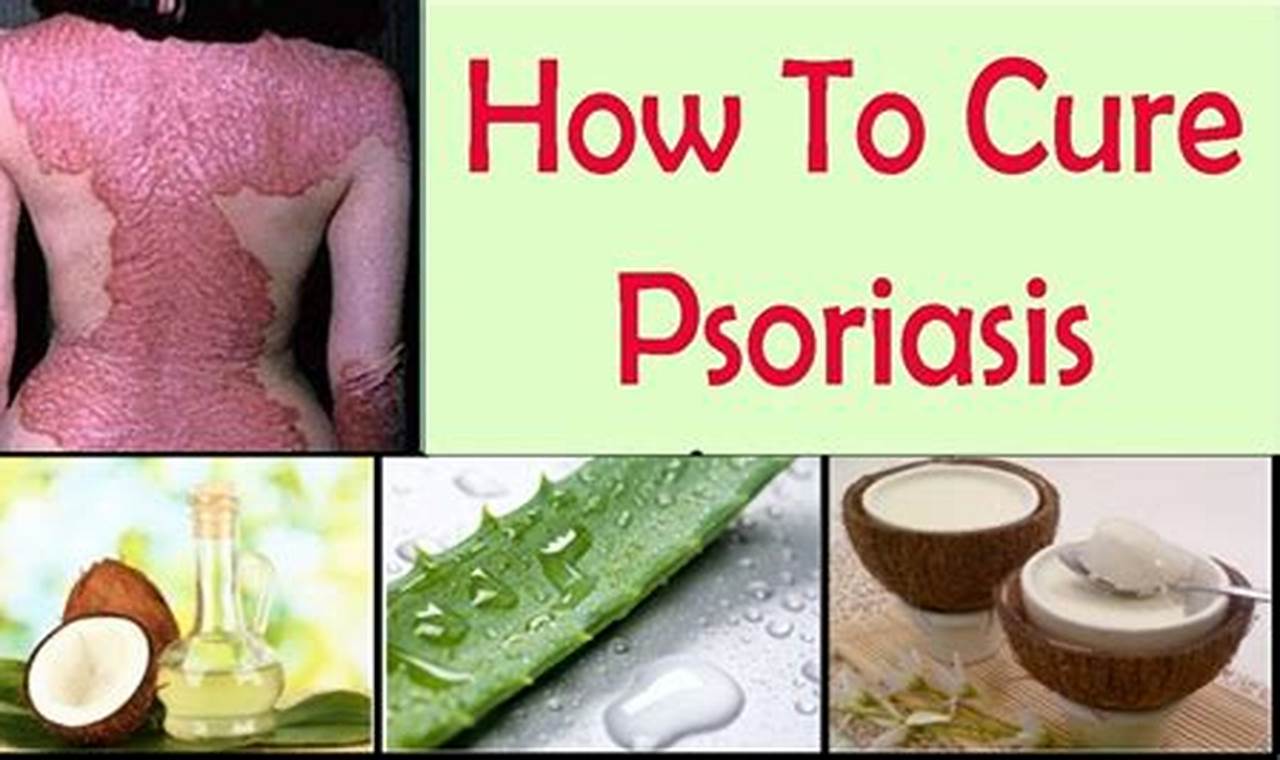 Best Natural Herbal Treatment for Psoriasis: Relief Guide | The Ultimate Herbal Remedies Guide: Natural Healing for a Healthier Life