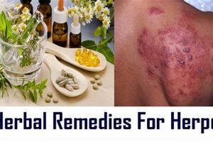 Natural Herpes Herbal Treatment: Relief & Remedies | The Ultimate Herbal Remedies Guide: Natural Healing for a Healthier Life