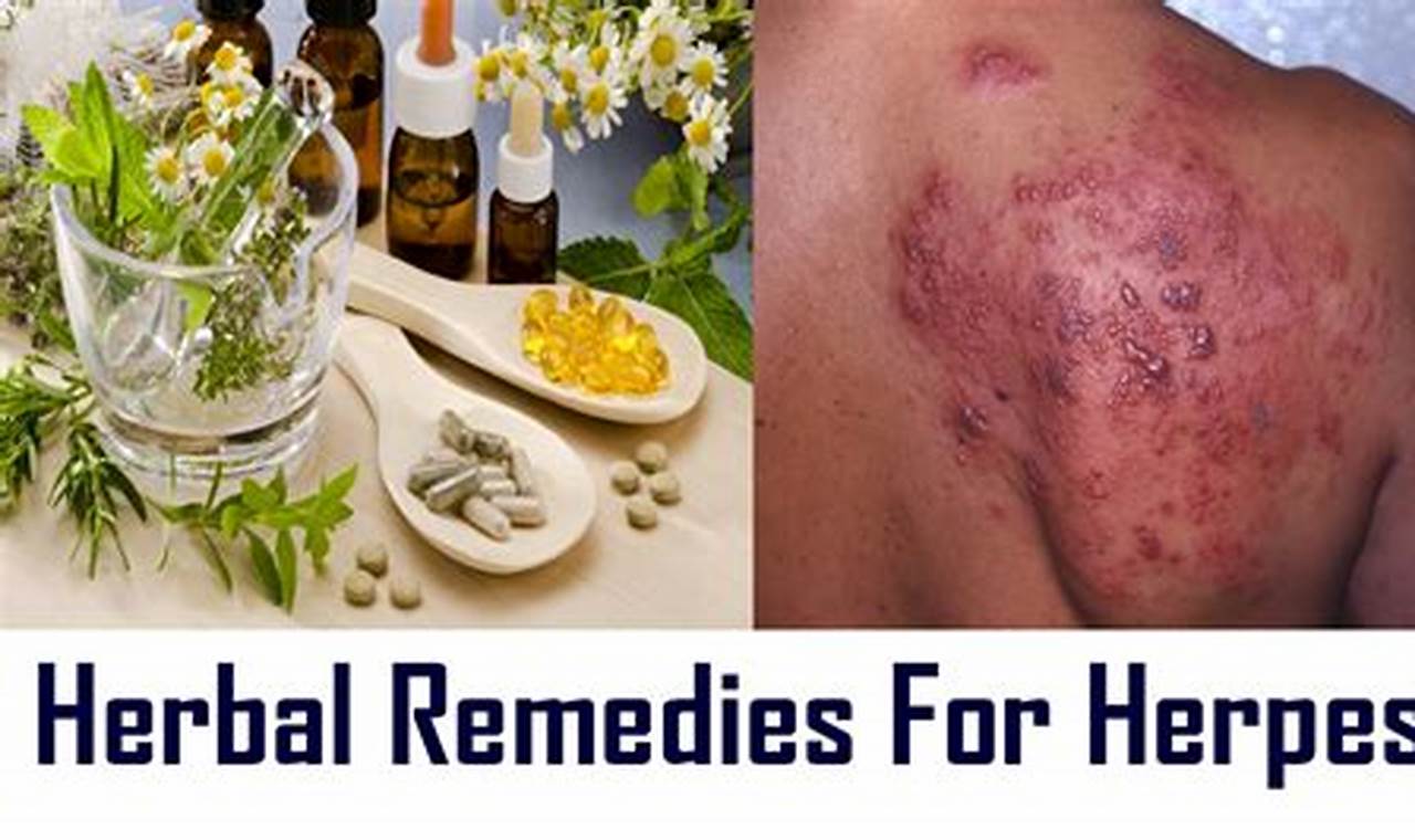 Natural Herpes Herbal Treatment: Relief & Remedies | The Ultimate Herbal Remedies Guide: Natural Healing for a Healthier Life